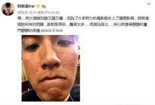 长痘特别严重的明星,揭秘长痘严重的明星护肤秘籍